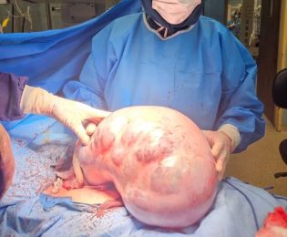 خارج‌ کردن توده ۱۰ کیلویی از شکم یک بیمار در کرج