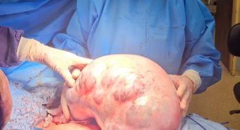 خارج‌ کردن توده ۱۰ کیلویی از شکم یک بیمار در کرج